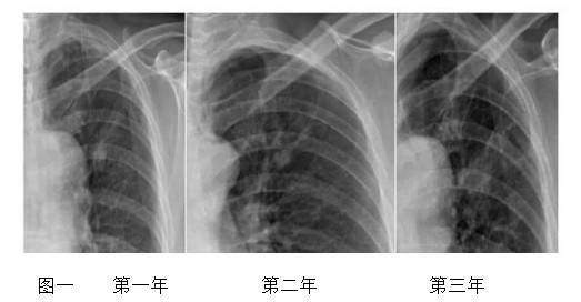 医学普及:如何减少静态DR肺癌临床误诊漏诊