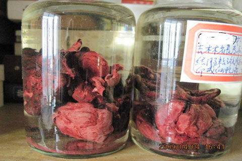 ��������η�ֹ��֢�ĸ�����ת��