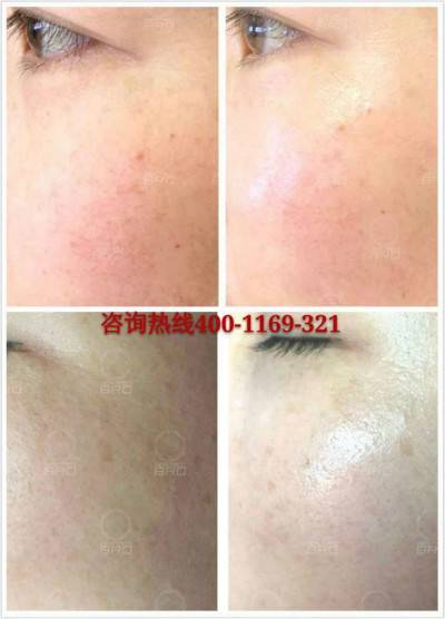 连美容院的美容师给客户做了BRD无针水光后都信心满满