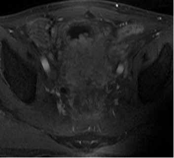 晚期直肠癌骨转移患者经A45治疗后血尿症状消失