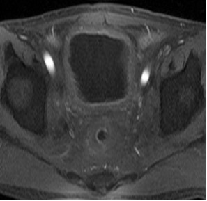 晚期直肠癌骨转移患者经A45治疗后血尿症状消失