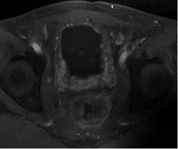 晚期直肠癌骨转移患者经A45治疗后血尿症状消失