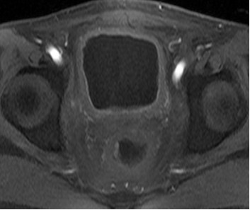 晚期直肠癌骨转移患者经A45治疗后血尿症状消失