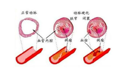 本轮雾霾锁城75万平方公里:面对雾霾 其实心脏比肺更脆弱