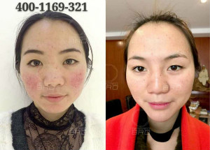 穷尽一生追随,只为等待和BRD无针水光这一刻的相遇!