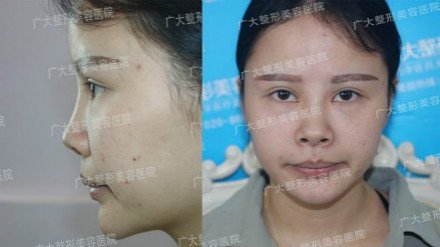 “华南鼻王”实力塑美广大,医术与艺术再次完美融合