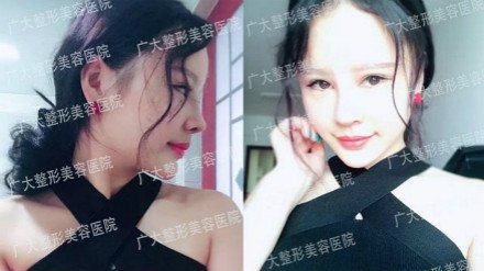 “华南鼻王”实力塑美广大,医术与艺术再次完美融合