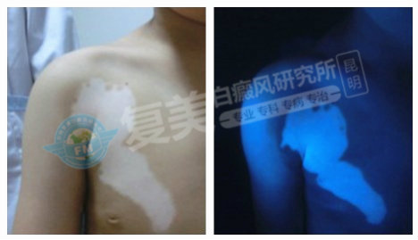 纳米波色素循环治疗仪?看他在昆明复美白癜风研究所亲身说法!