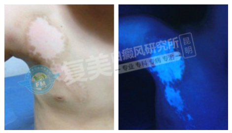 纳米波色素循环治疗仪?看他在昆明复美白癜风研究所亲身说法!