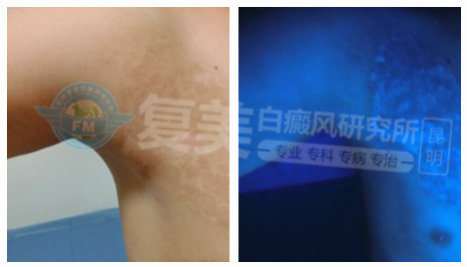 纳米波色素循环治疗仪?看他在昆明复美白癜风研究所亲身说法!