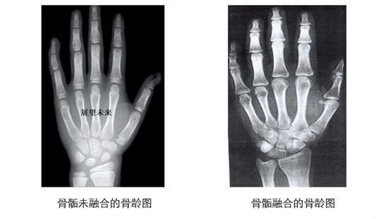 三门峡哪里能评估骨龄呢?