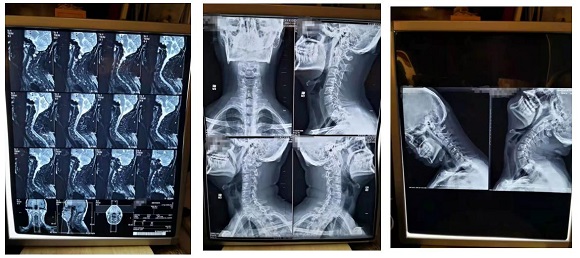 蒋氏正脊诊疗颈椎健康5种类型 弥补“颈椎病分型诊疗5种类型”的缺失