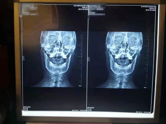 蒋氏正脊诊疗颈椎健康5种类型 弥补“颈椎病分型诊疗5种类型”的缺失