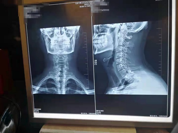 蒋氏正脊诊疗颈椎健康5种类型 弥补“颈椎病分型诊疗5种类型”的缺失
