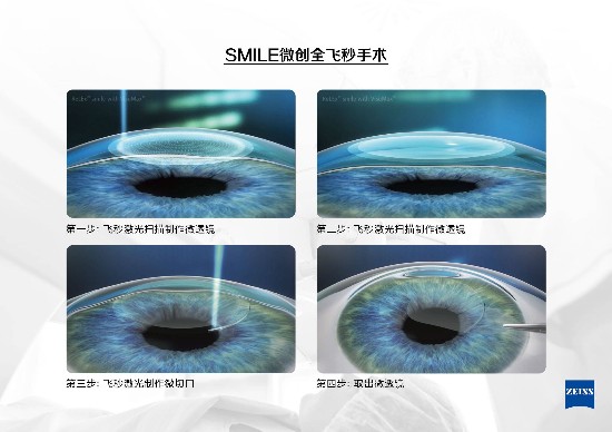 成都全飞秒近视手术到底是怎么做的?华西双博士为你解答